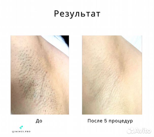 Диодный лазер «Lumines» Max Plus 2000вт