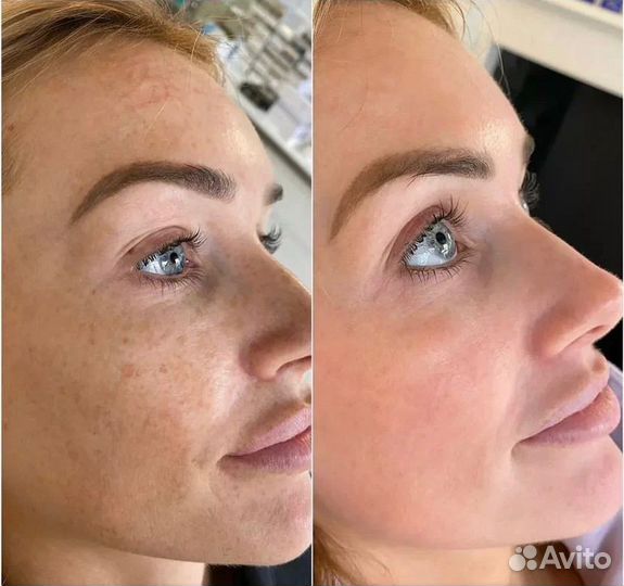 Morpheus 8 RF lifting #1 в мире