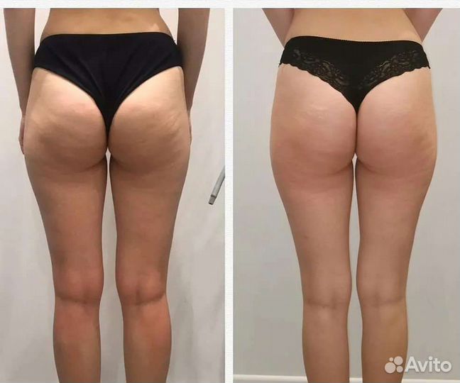 Антицеллюлитный массаж