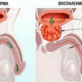 Массаж предстательной железы (простаты)