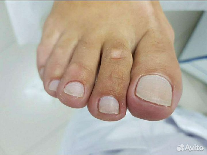 Медицинский педикюр. Подолог. Выезд на дом