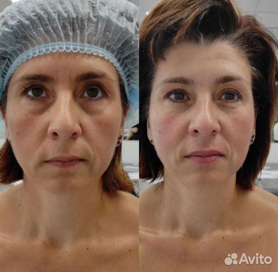 Косметолог. Чистка лица.Массажи