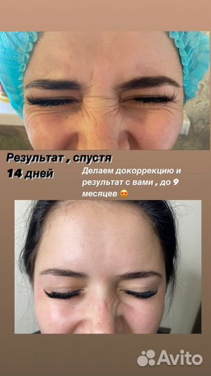 Ботокс.Косметология