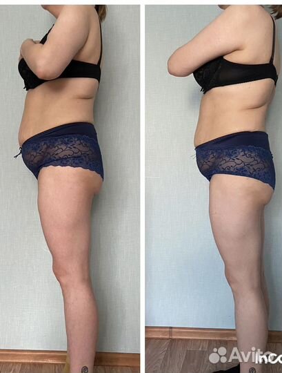 Антицеллюлитный массаж