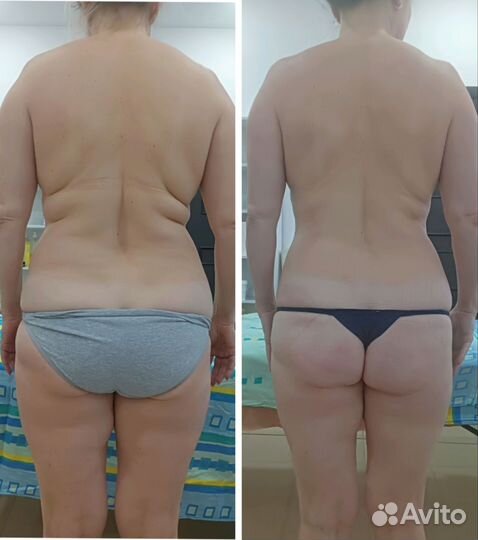 Массаж. Аппаратная коррекция фигуры. Снижение веса