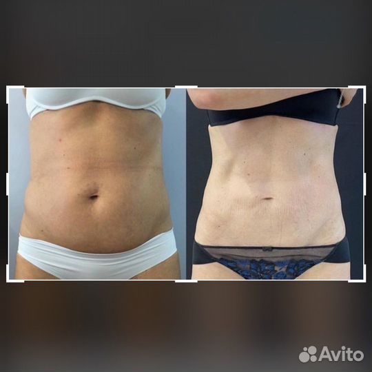 Криолиполиз (4 насадки одновременно)