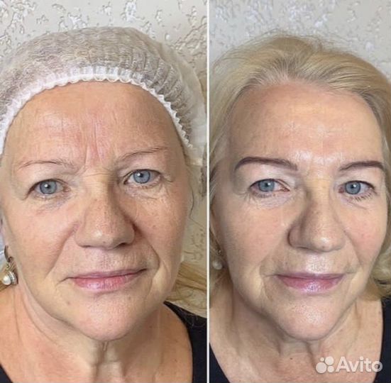 Фракционный РФ лифтинг микроигольчатый