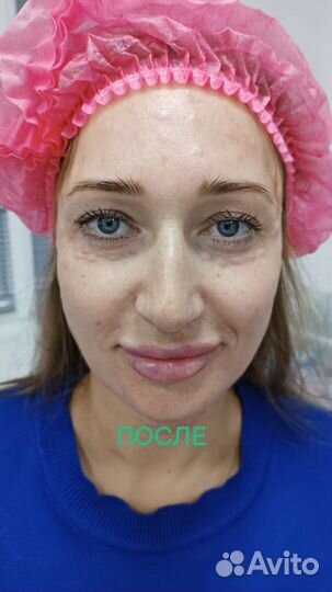 Биоревитализация