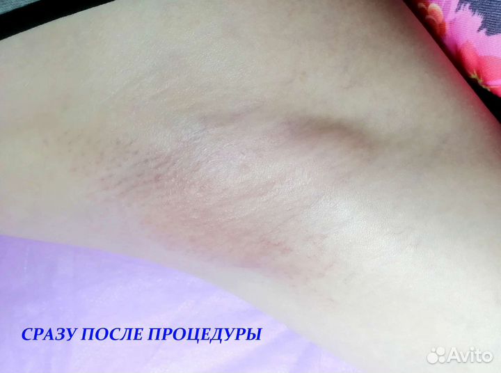 Электроэпиляция для женщин и мужчин