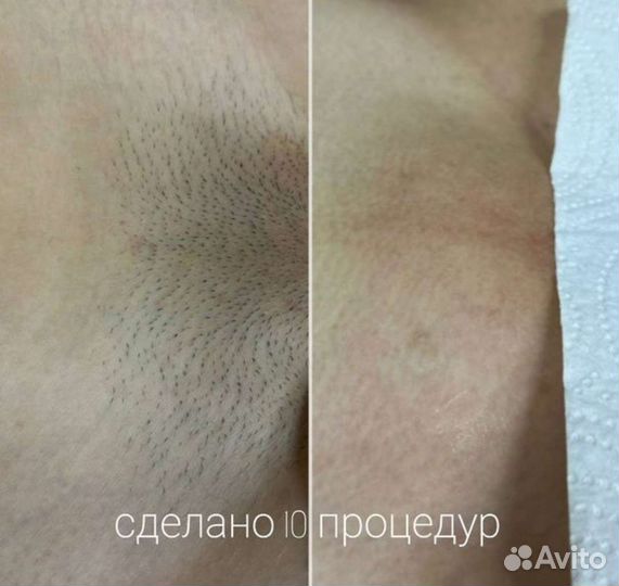 Фотоэпиляция