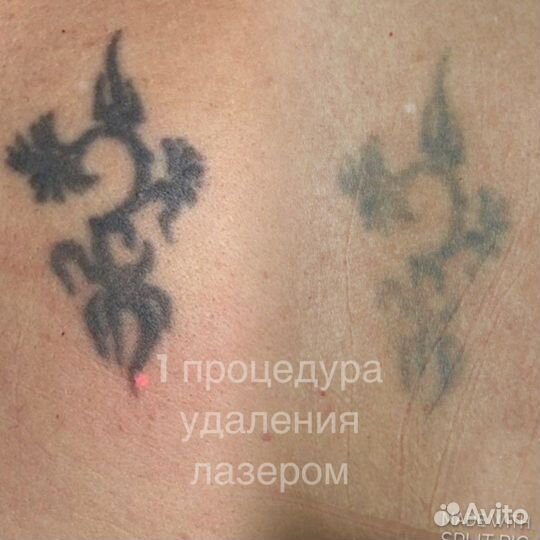 Лазерное удаление татуажа
