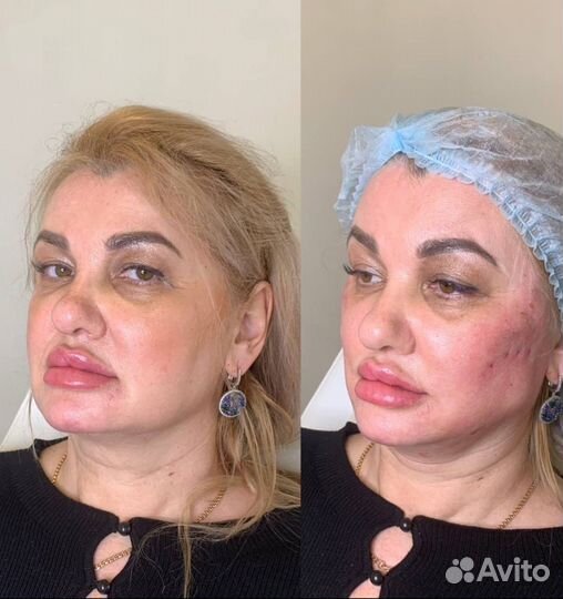 Подтяжка лица нитями ког мезонити моно