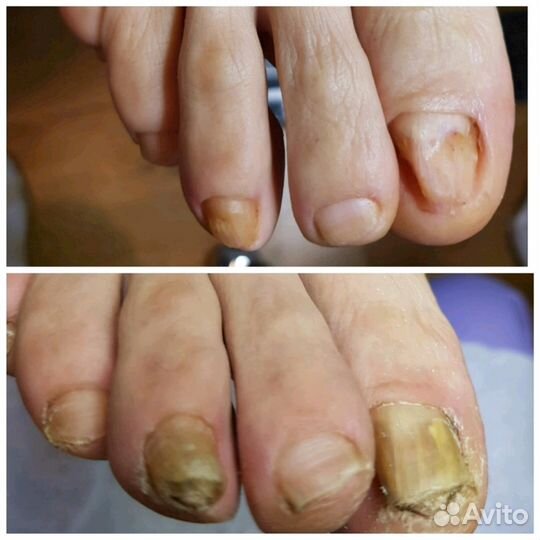 Вросший ноготь, трещены, мозоли, бородавки