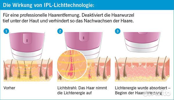 Система удаления волос (Германия) технология IPL