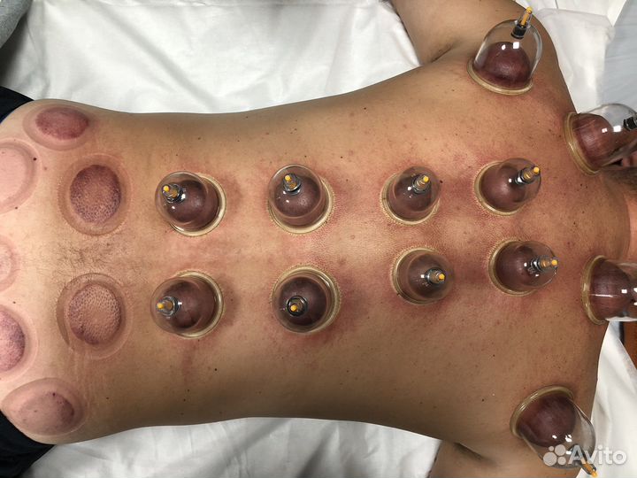 Вакуумные банки