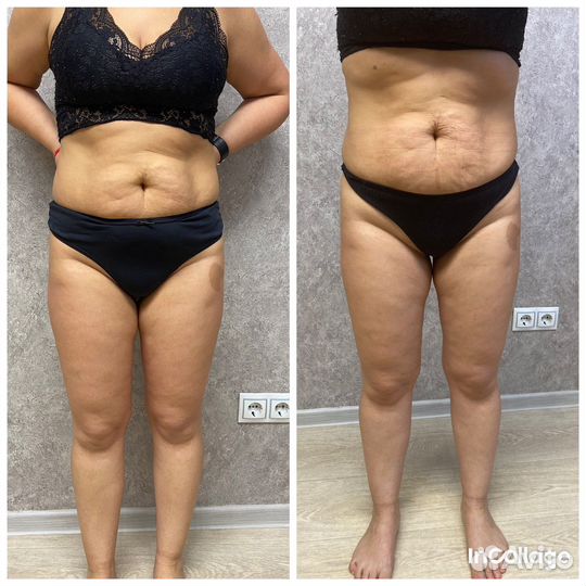 Антицеллюлитный массаж