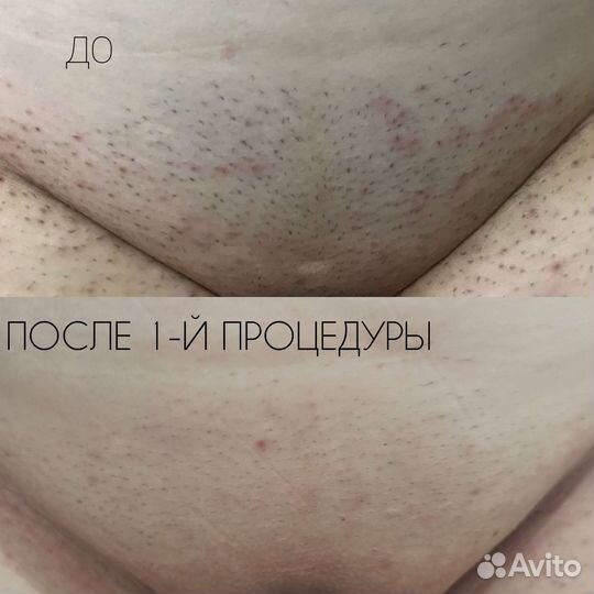 Лазерная эпиляция