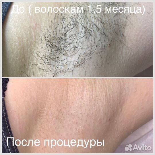 Шугаринг) Сахарная депиляция Тихорецк