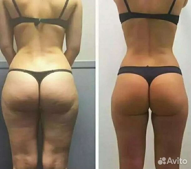 Антицеллюлитный массаж. Старвак. LPG. Похудение