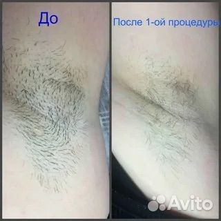 Пинцетный метод электроэпиляции