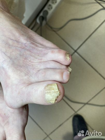 Педикюр, подолог,вросший ноготь, трещины,мозоли