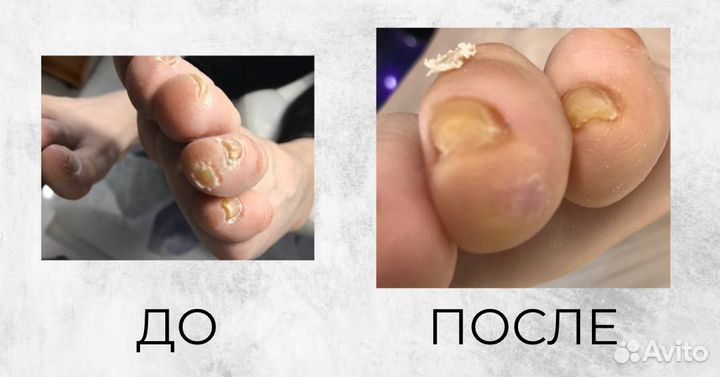 Мастер педикюра/сложные стопы/трещины/мозоли