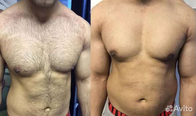 Депиляция, шугаринг