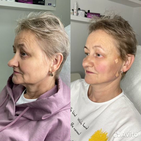 Подтяжка лица, брыли, мезонити, золотые нити