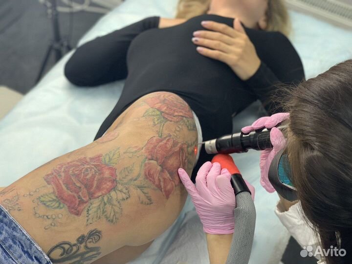 Удаление тату / Результат сразу