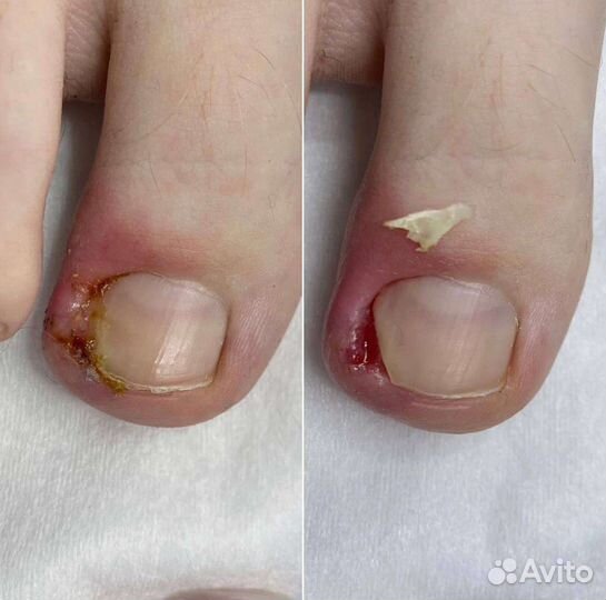 Педикюр подолог