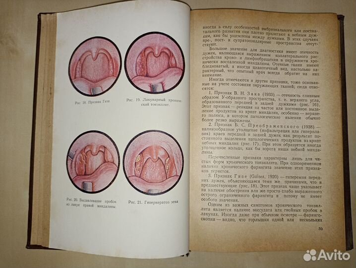 Хронический тонзиллит и его связь с другими заболе