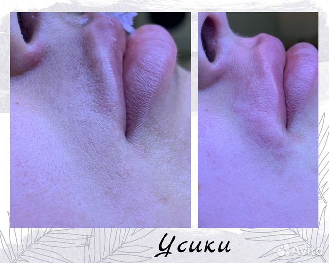 Электроэпиляция: бёдра