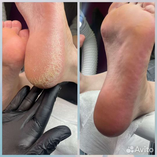 Педикюр бесплатно