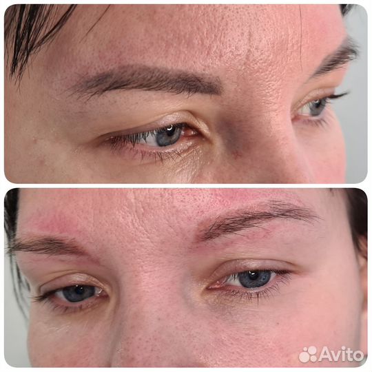 Удаление татуировки/татуажа лазером