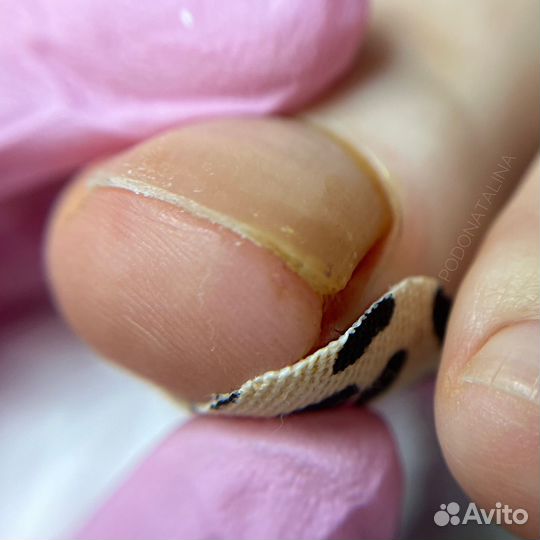 Модель подологу вросшие ногти трещины травмы