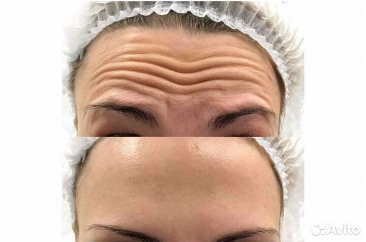 Косметолог, ботокс, био, мезо