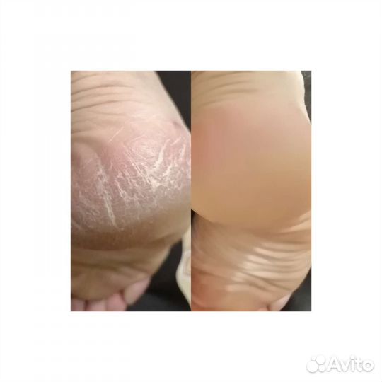 Педикюр на дому