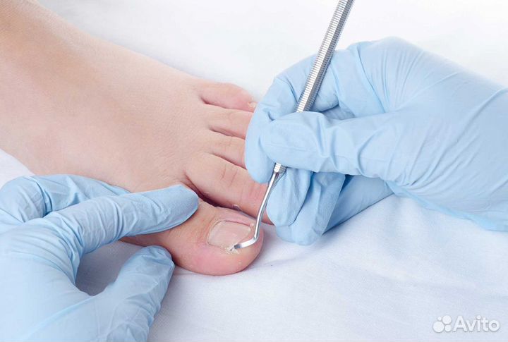 Лечебный педикюр