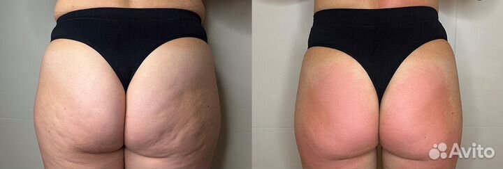 Нужна модель на эндосферу тела / аппаратный массаж