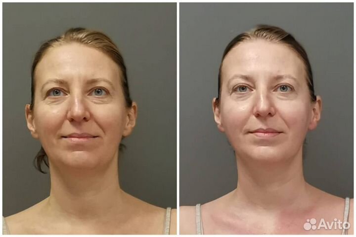 Скульптурирующий массаж лица