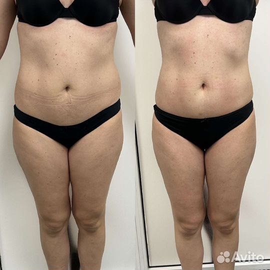 Вакуумный аппаратный массаж, обертывание