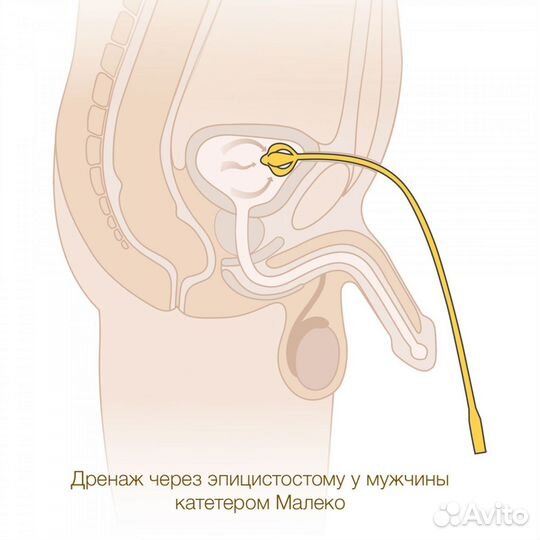 Катетер Малеко Медерен