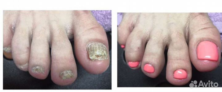 Медицинский педикюр, подолог,выезд на дом