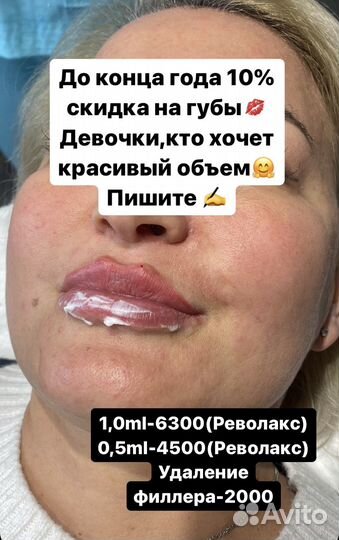 Увеличение губ