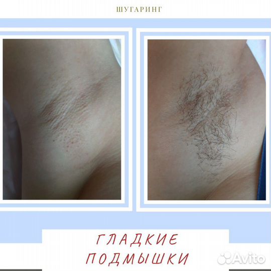 Шугаринг Ваксинг