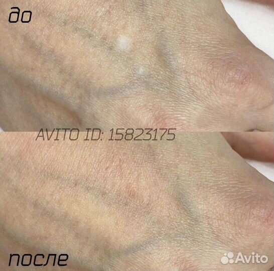 Удаление шрамов Камуфляж рубцов растяжек витилиго