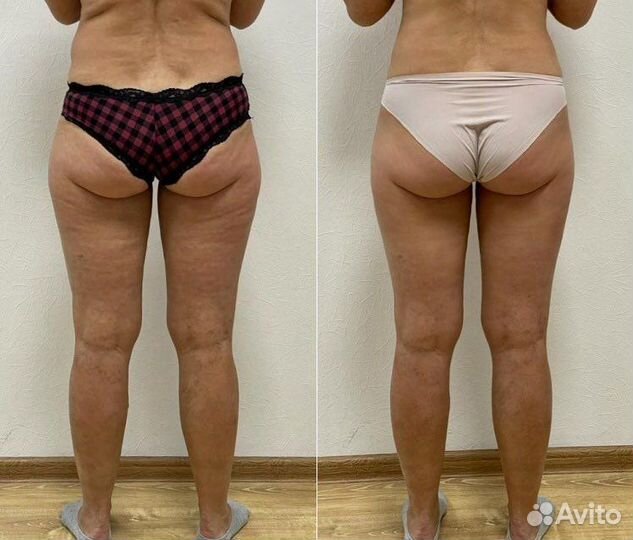 Lpg массаж в Санкт-Петербурге