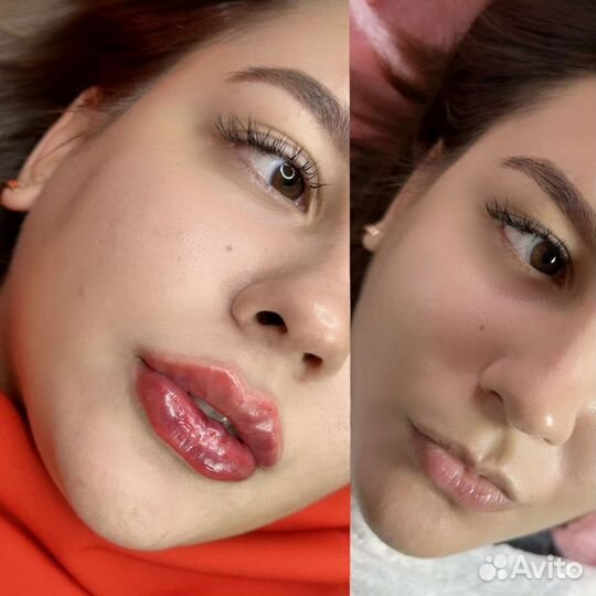 Косметолог Увеличение губ Контурная Fullface