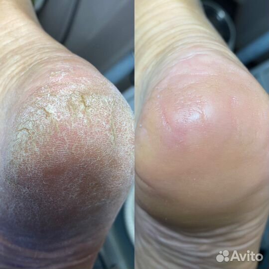 Подолог.Профессиональный педикюр. Срочный заказ