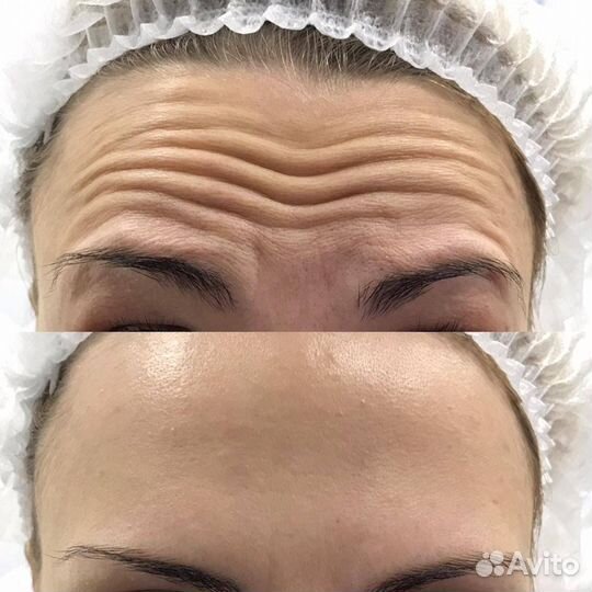 Ботокс для лица